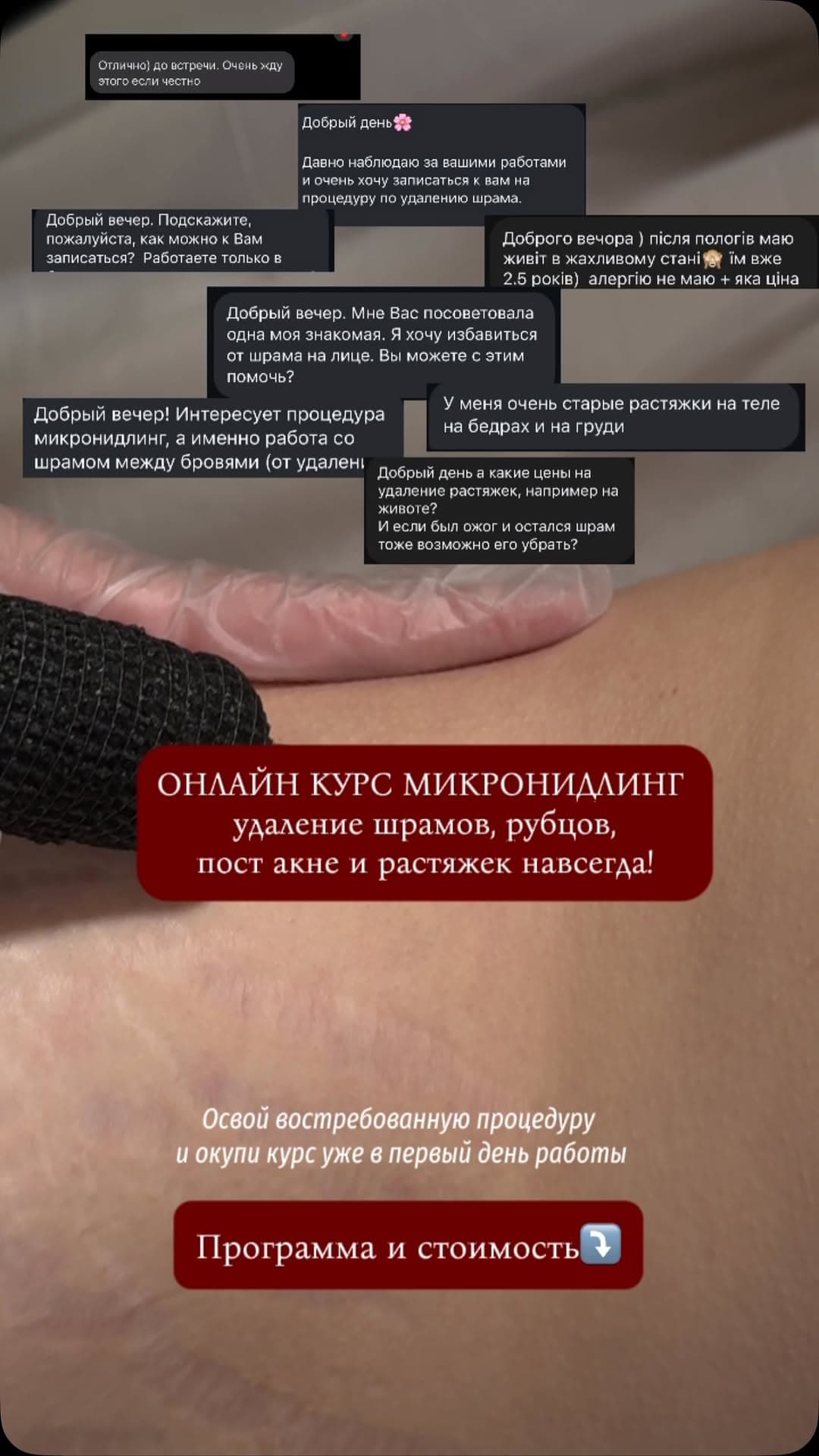 Microneedling