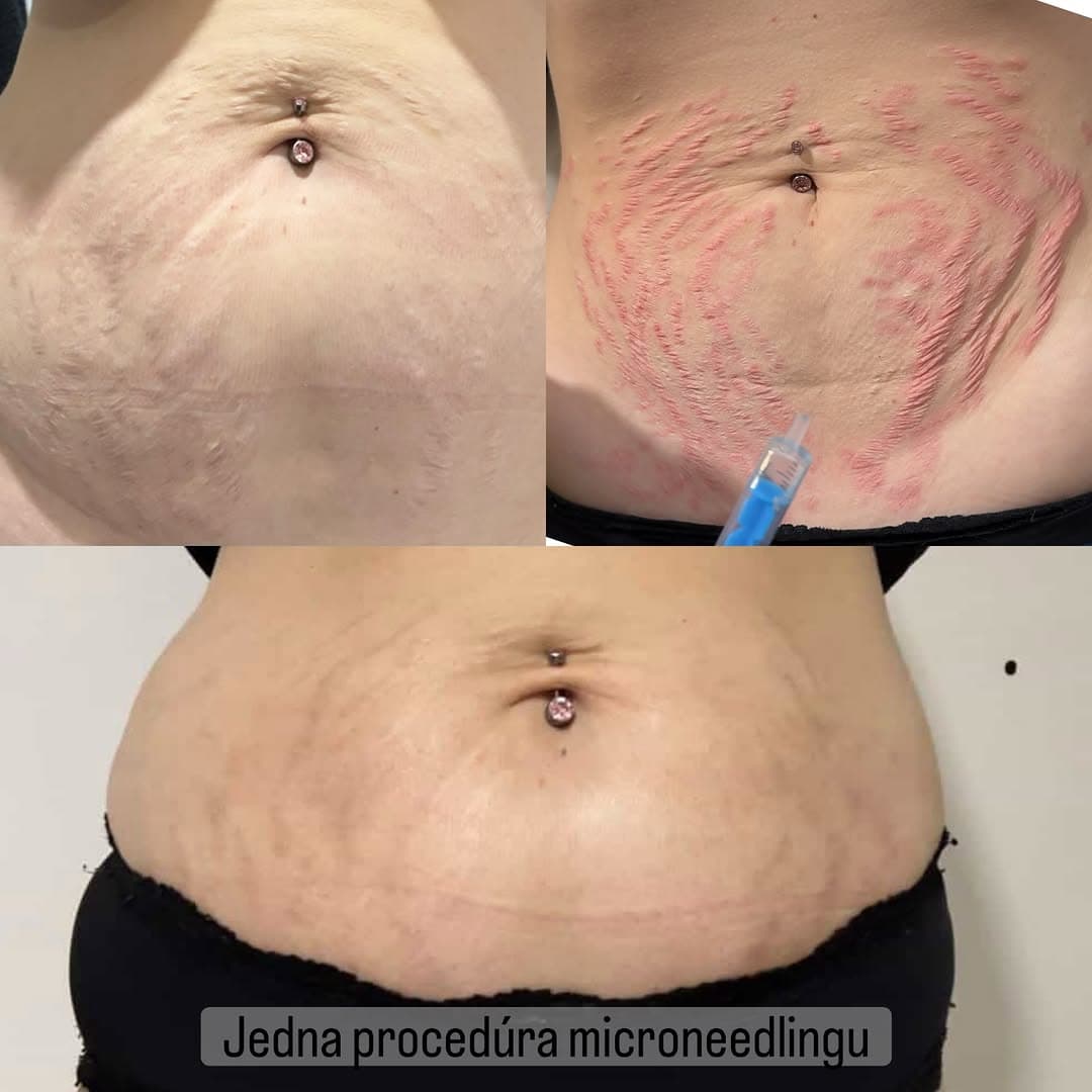 Microneedling