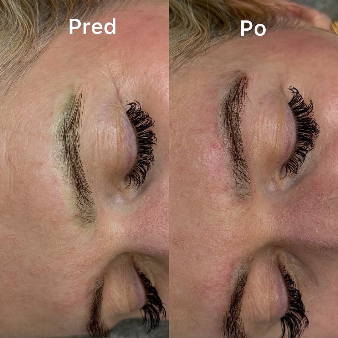Microneedling